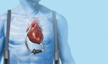 Cardiac Assist Devices Market
