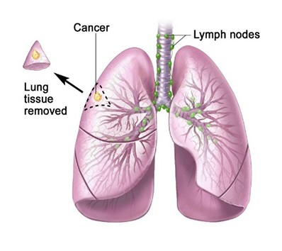 Global Non-Small Cell Lung Cancer Treatment Market Is Estimated To Witness High Growth Owing To Increasing Prevalence of Lung Cancer and Advanced Treatment Options