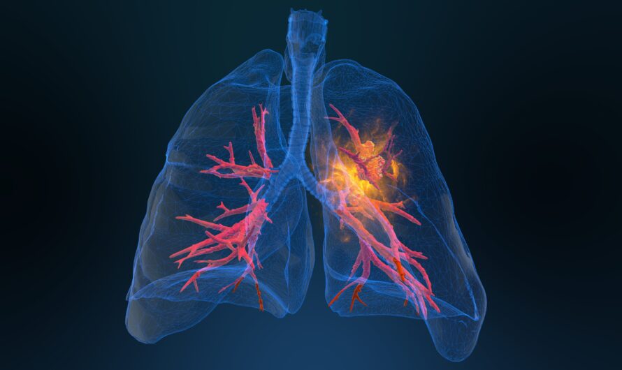 New Scoring System Predicts Survival in Lung Cancer Patients