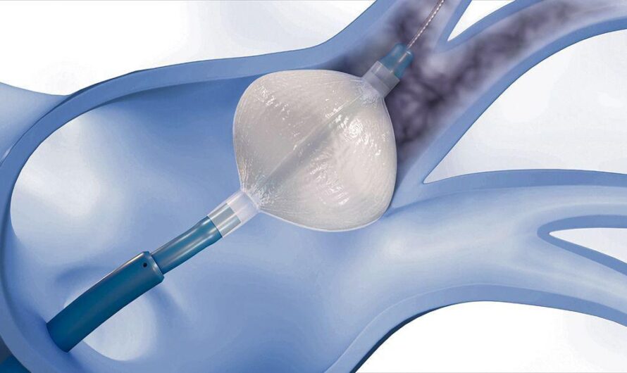 Balloon Angioplasty is the largest segment driving the growth of Inflation Devices Market
