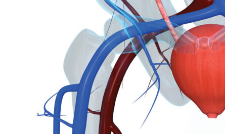 Prostatic Artery Embolization Market