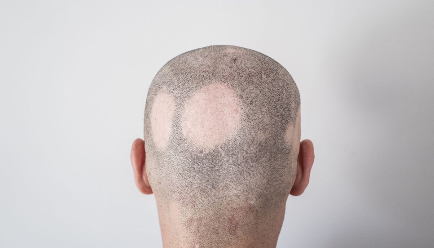 Alopecia Treatment Market