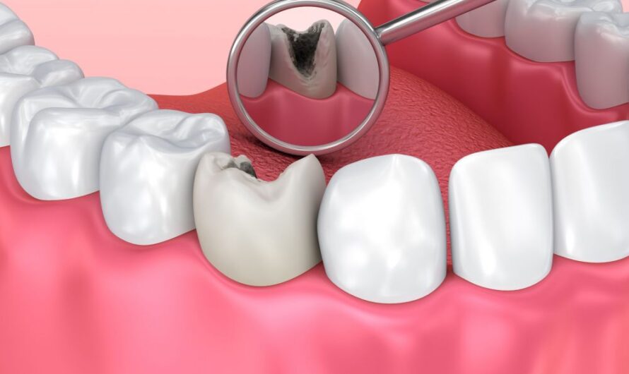 Dental Caries Treatment Market Propelled by Rising Prevalence of Dental Caries