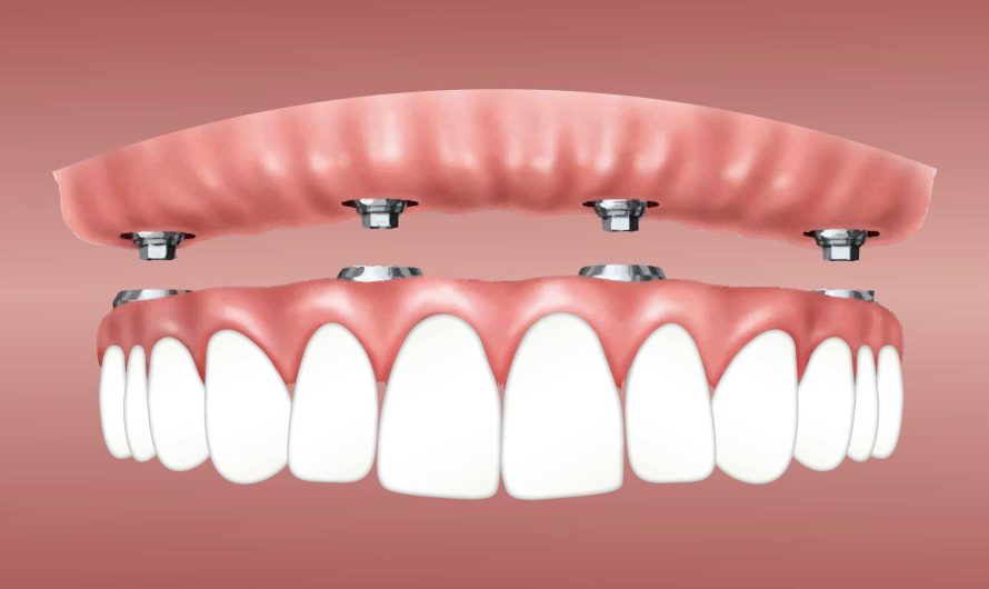 Rising Demand For Aesthetic Dentistry Drives Growth Of The Global Dental Implants Market