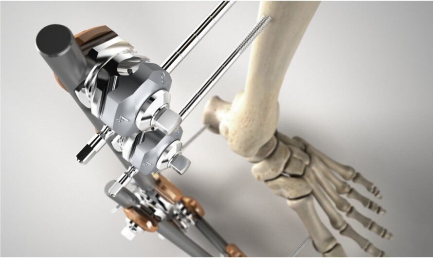 The Global External Fixators Market Is Estimated To Propelled By The Growing Prevalence Of Orthopedic Injuries