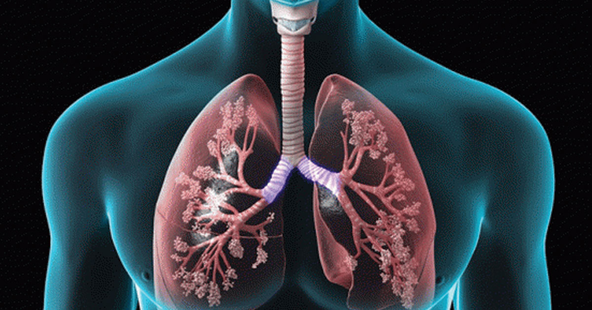 Chronic Obstructive Pulmonary Disease (COPD) Treatment Market
