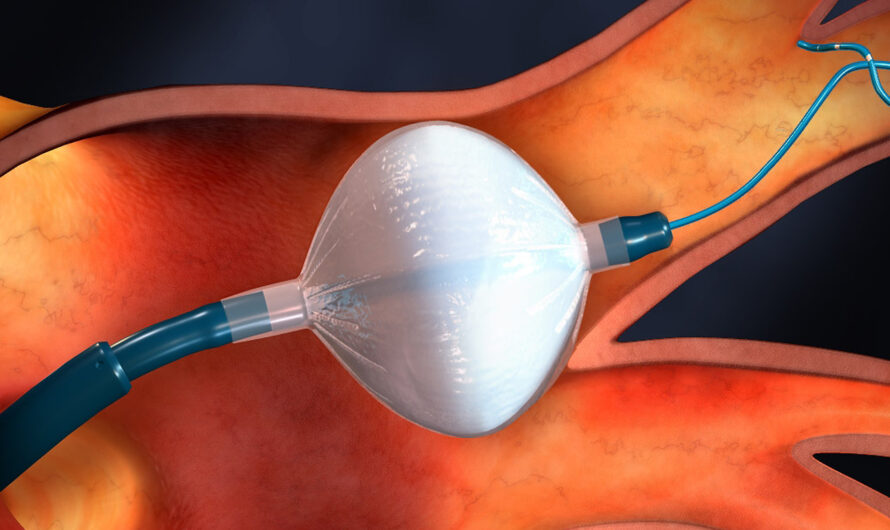 Cryoablation Devices: A Promising Technology For Minimally Invasive Cancer Treatment