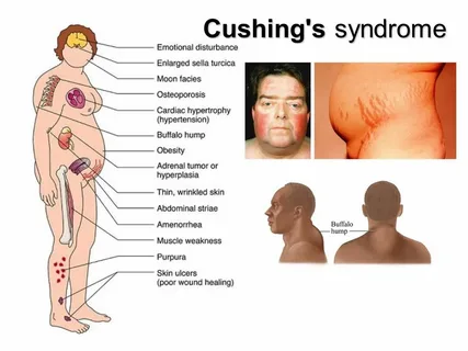 Remission of Cushing’s Disease Linked to Increased Risk of Autoimmune Disease Development