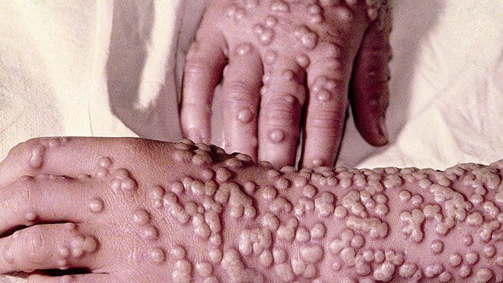 Smallpox Treatment Market