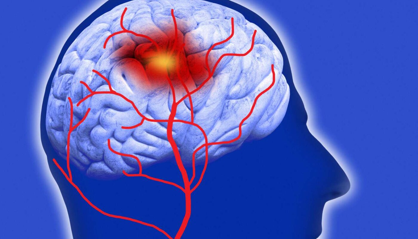 Traumatic Brain Injury Therapeutics Market