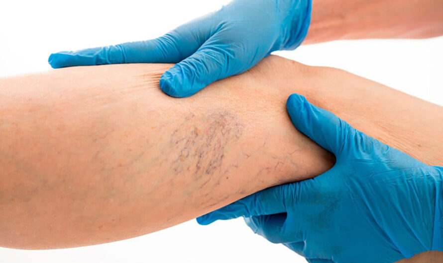 Varicose Vein Treatment Devices: The Evolution of Care