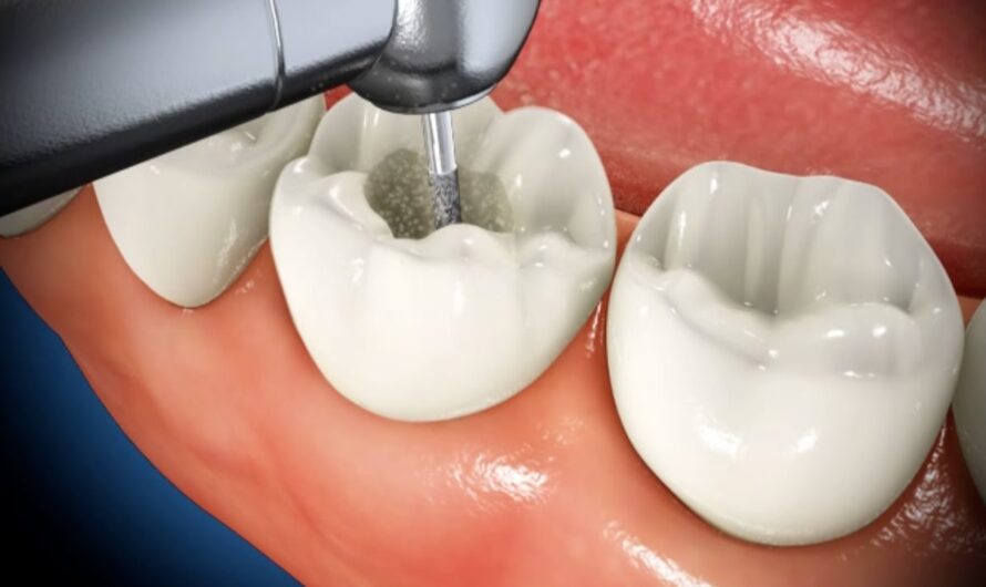 Dental Caries Treatment: Restoring Smiles and Preventing Tooth Decay