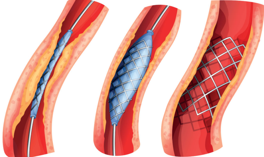 Global Lung Stent Market is Estimated to Witness High Growth Owing to Technological Advancements in Targeted Therapies