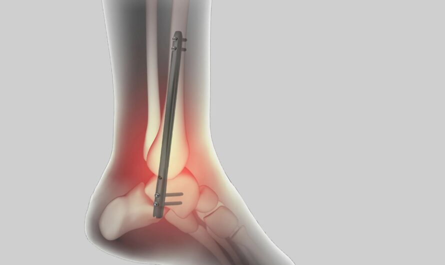 Evolution of the Global Ankle Fusion Nail Market
