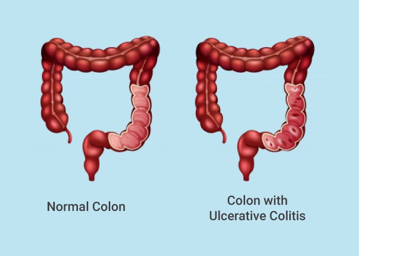 United Kingdom Ulcerative Colitis Industry: Living with Ulcerative Colitis in the United Kingdom